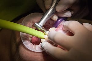 dentist fixing implants